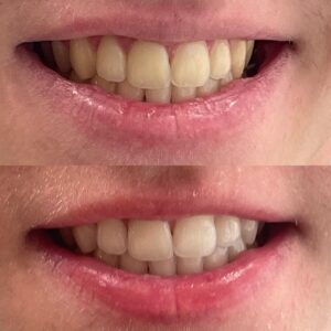 Clareamento Dental Dentista Adriana Koeppel