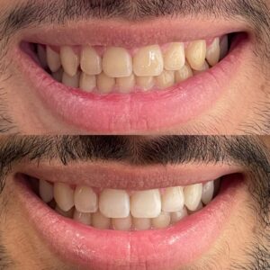 Clareamento Dental Dra. Adriana Koeppel Dentista