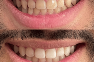 Clareamento Dental Dra. Adriana Koeppel Dentista em BH.
