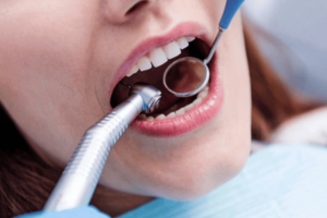 Dra. Adriana Koeppel Dentista Especialista em Remoção de Tartaro e Profilaxia