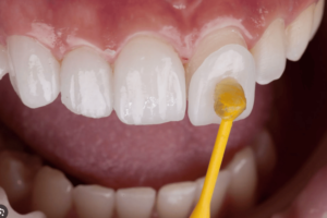 Facetas Dentarias Dra. Adriana Koeppel Especialista
