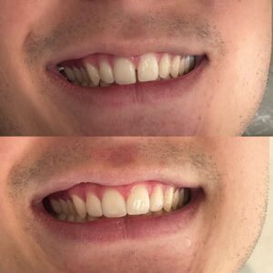 Fechamento de diastema Dra. Adriana Koeppel Especialista