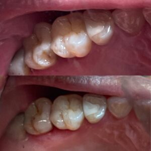 Fratura Dental Dentista Dra. Adriana Koeppel
