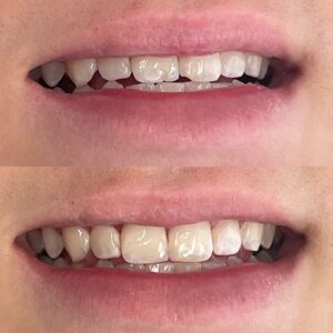 Fratura Dental Dra. Adriana Koeppel Dentista