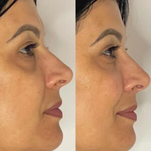 Preenchimento Facial Dra. Adriana Koeppel Especialista