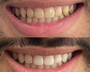 Clareamento Dental em Belo Horizonte - Dra. Adriana Koeppel