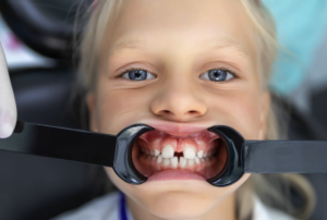 Fechamento De Diastema em Belo Horizonte - Dra. Adriana Koeppel