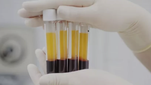 IPRF | Plasma rico em fibrina injetável em Belo Horizonte - Dra. Adriana Koeppel