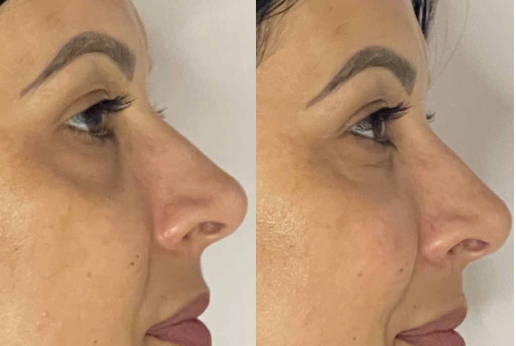 Preenchimento Facial em Belo Horizonte - Dra. Adriana Koeppel
