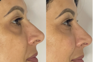 Preenchimento Facial em Belo Horizonte - Dra. Adriana Koeppel