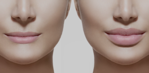 Preenchimento Labial em Belo Horizonte - Dra. Adriana Koeppel