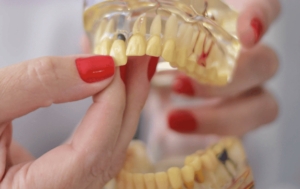 Restaurações Estéticas | Fratura Dental em Belo Horizonte - Dra. Adriana Koeppel