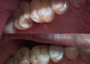 Restaurações Estéticas | Fratura Dental em Belo Horizonte - Dra. Adriana Koeppel