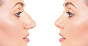 Harmonização facial sem cirurgia em BH MG