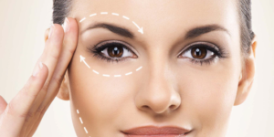 Fios de Sustentação em Belo Horizonte: Lifting Facial Sem Cortes