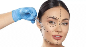 Harmonização orofacial sem cirurgia para rosto redondo em BH: opções?